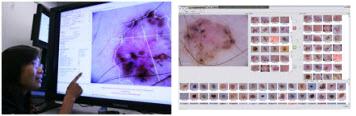 intel_demoscopy_skin_cancer_technology intel demoscopy skin cancer technology