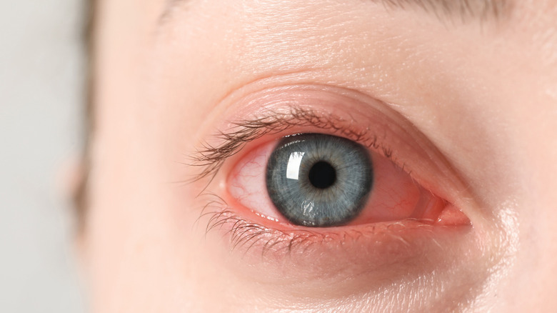 Closeup of a red and bloodshot eye.