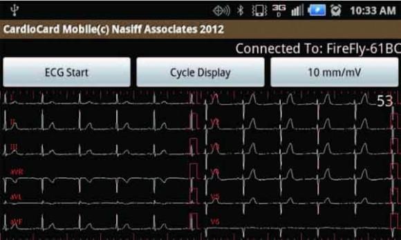 ekg