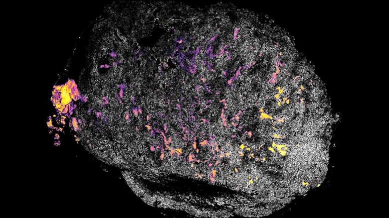 Cancer tumor treated with IL-12