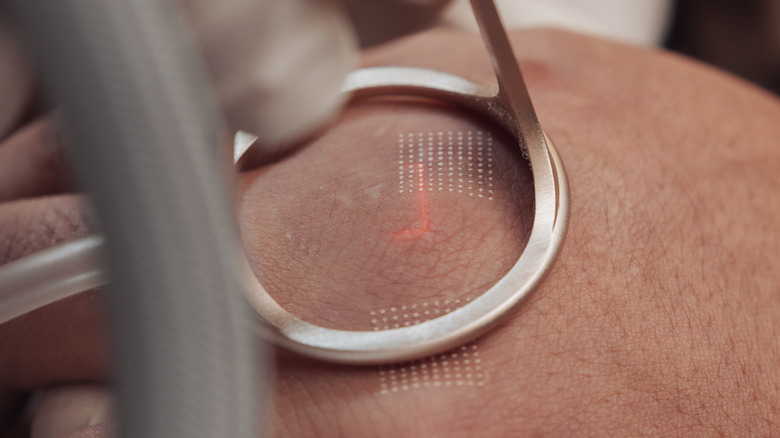 Close-up of fractional CO2 laser treatment