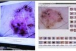 intel_demoscopy_skin_cancer_technology