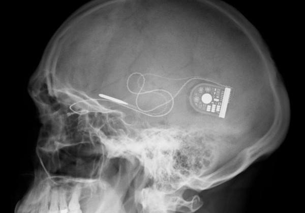 X-ray-showing-position-of-chip-and-power-supply-c-Oxford-Eye-Hospital-590x485