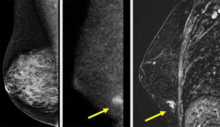 stereo mammogram