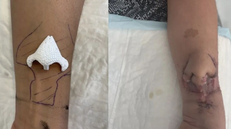 Woman has bioprinted nose grown on her arm