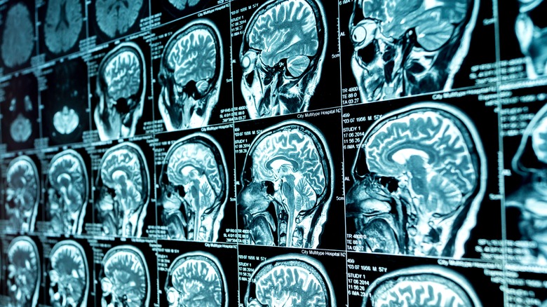 MRI scans of brains