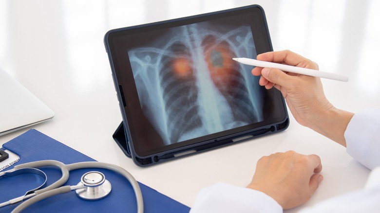 X-ray chest image on digital screen