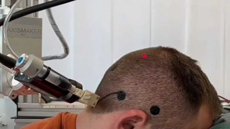A robotic arm applies an electric tattoo on the scalp of a patient.
