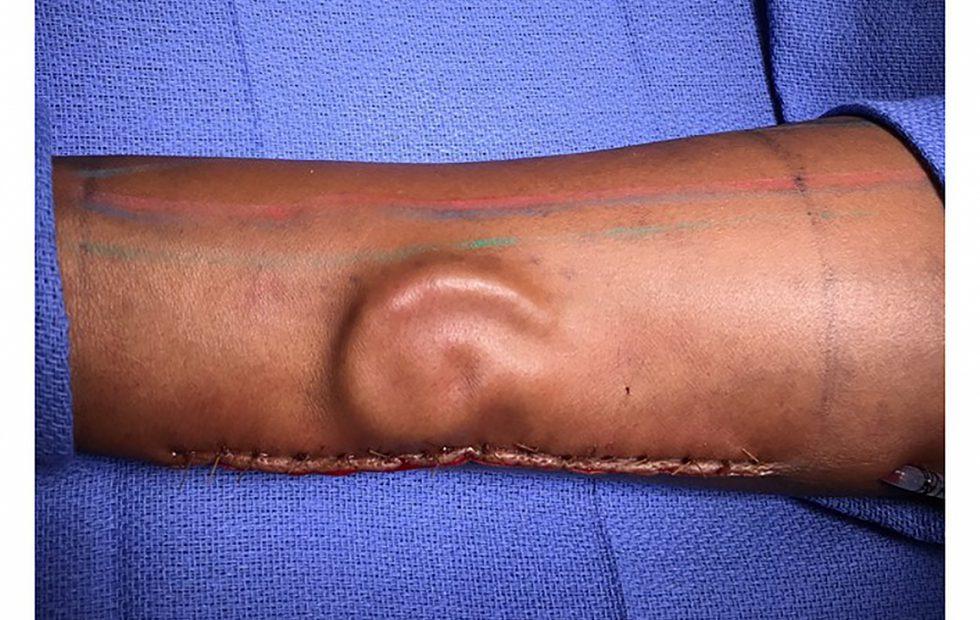 After losing her ear, soldier grows a replacement – on her arm