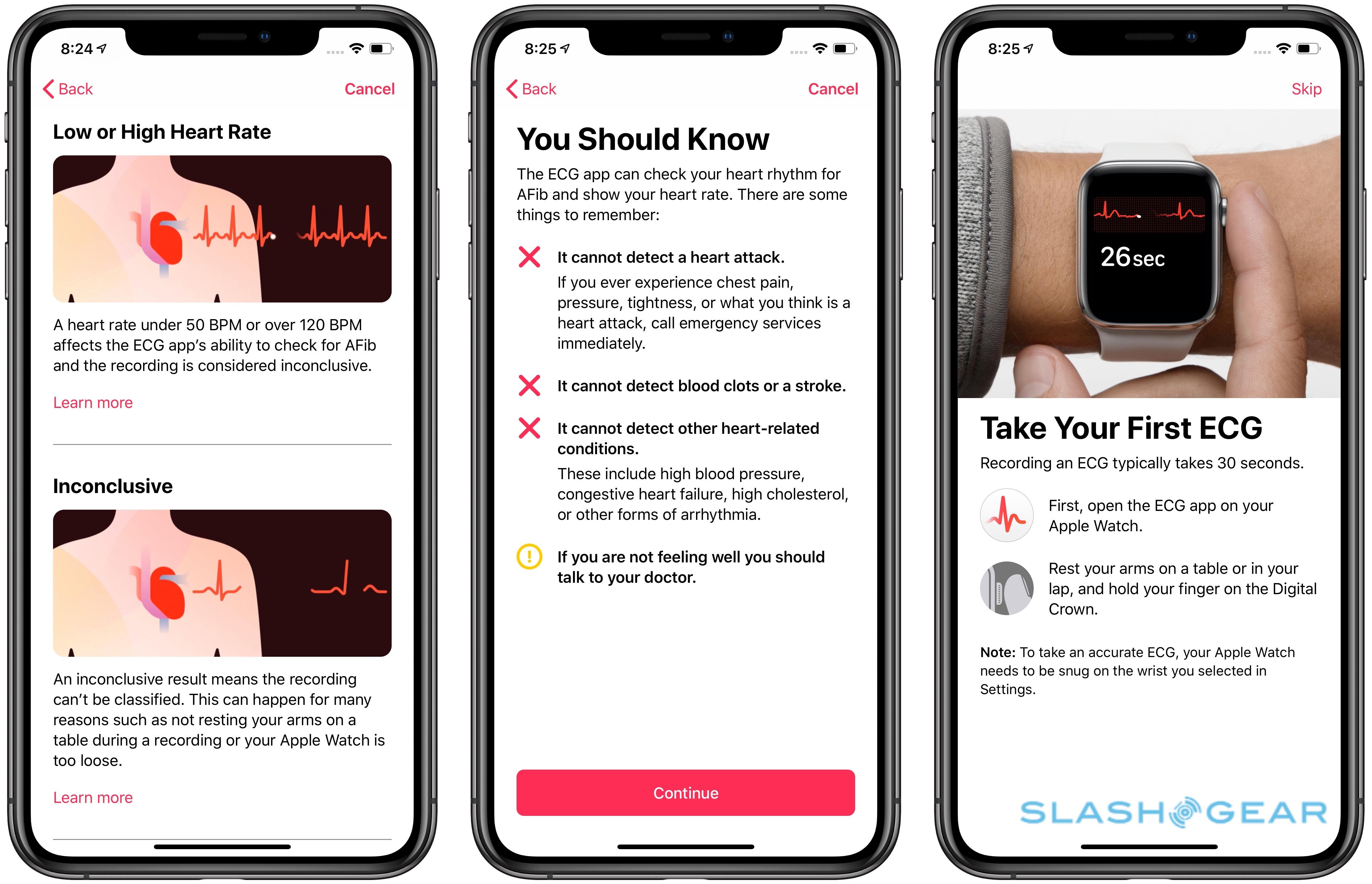 apple watch ecg reddit