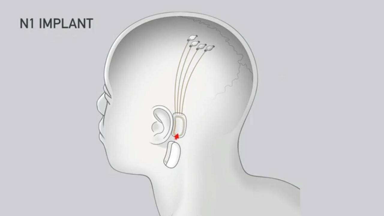 Elon Musk’s Neuralink will put tiny threads in brains to control devices