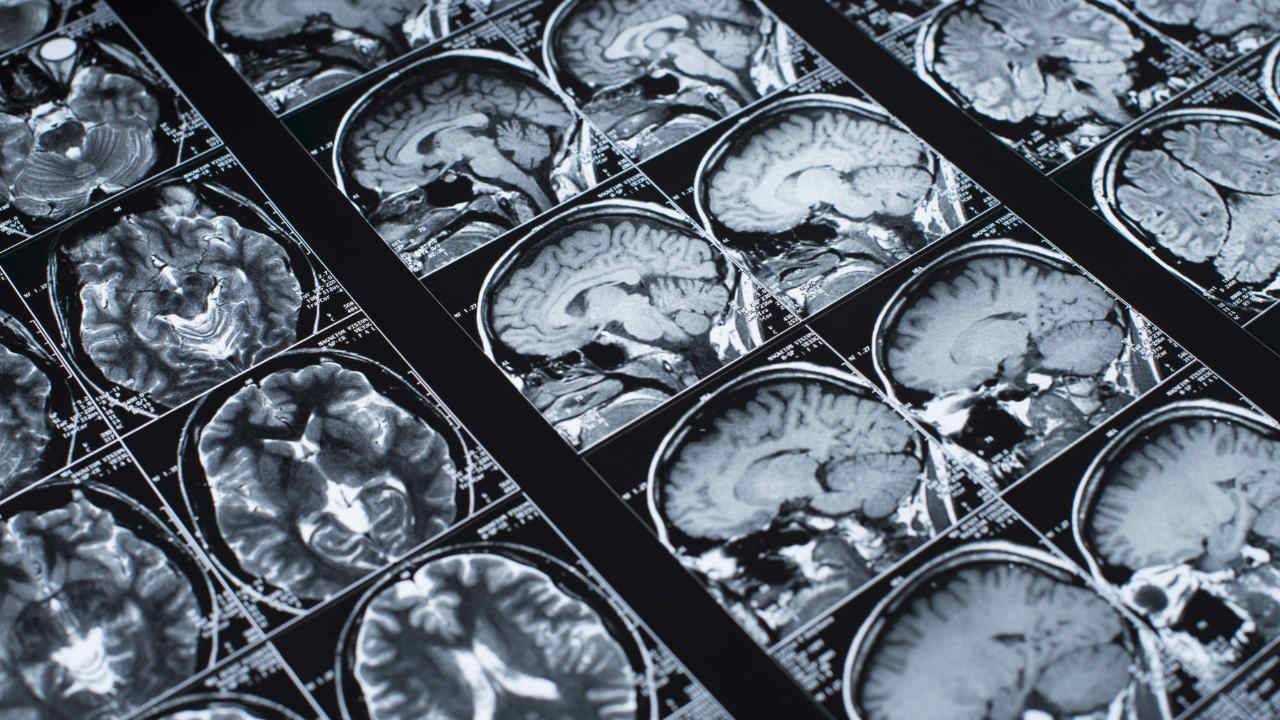 Standard blood pressure control may not be enough to protect the brain