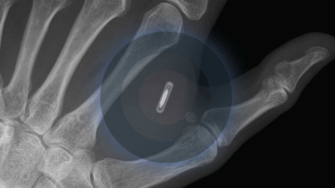 DIY bioimplant project aims to start a Tesla