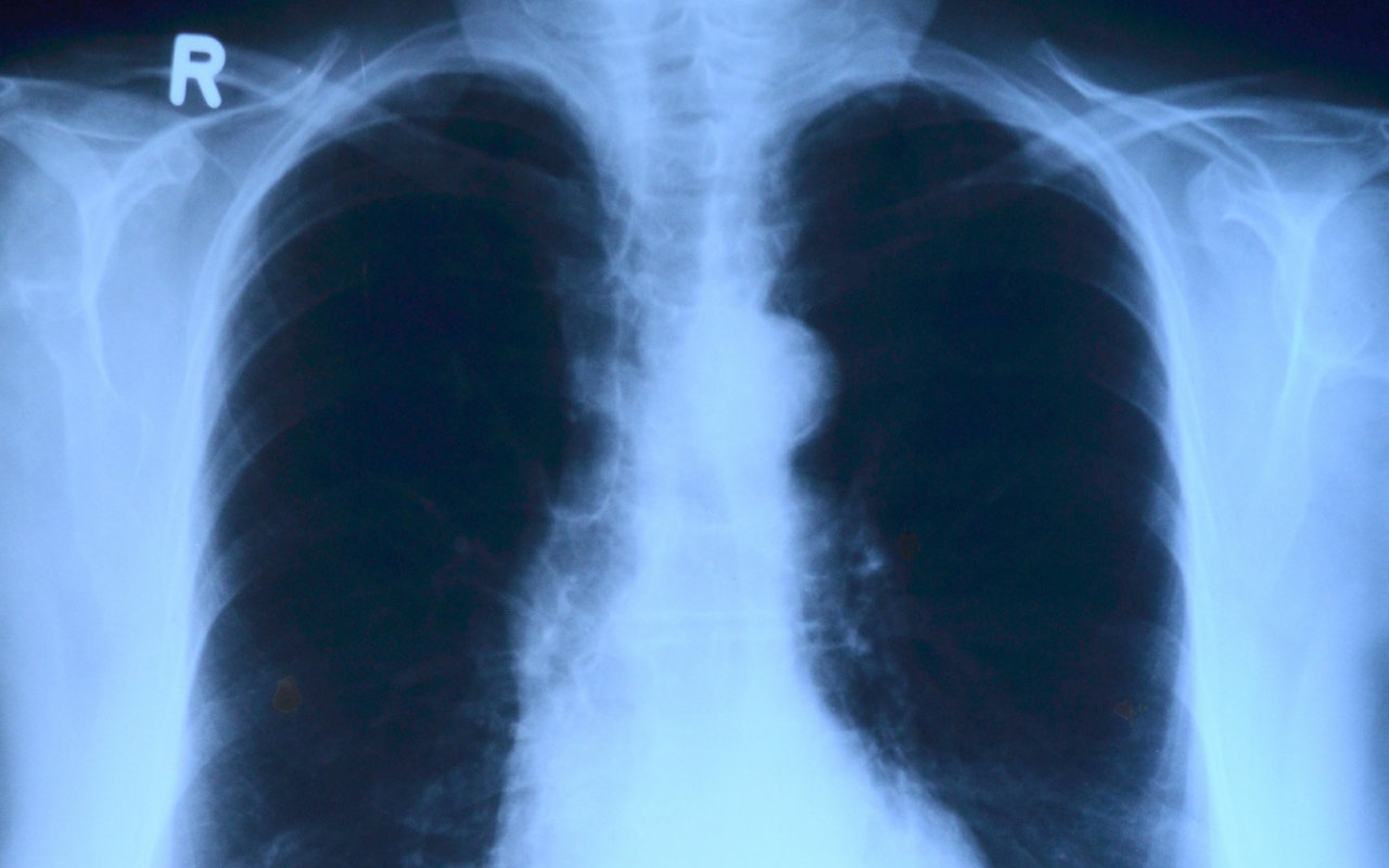 CDC finds strong evidence linking vitamin E acetate to EVALI outbreak