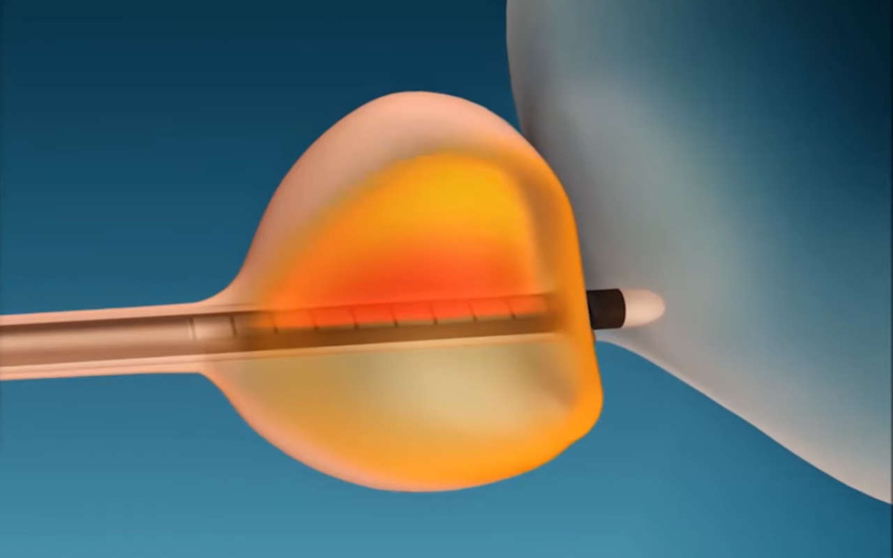 Lowrisk ultrasound procedure revolutionizes prostate cancer treatment