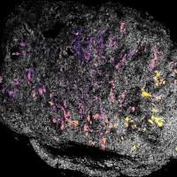 Cancer-targeting treatment “steps on the gas” to kill tumors