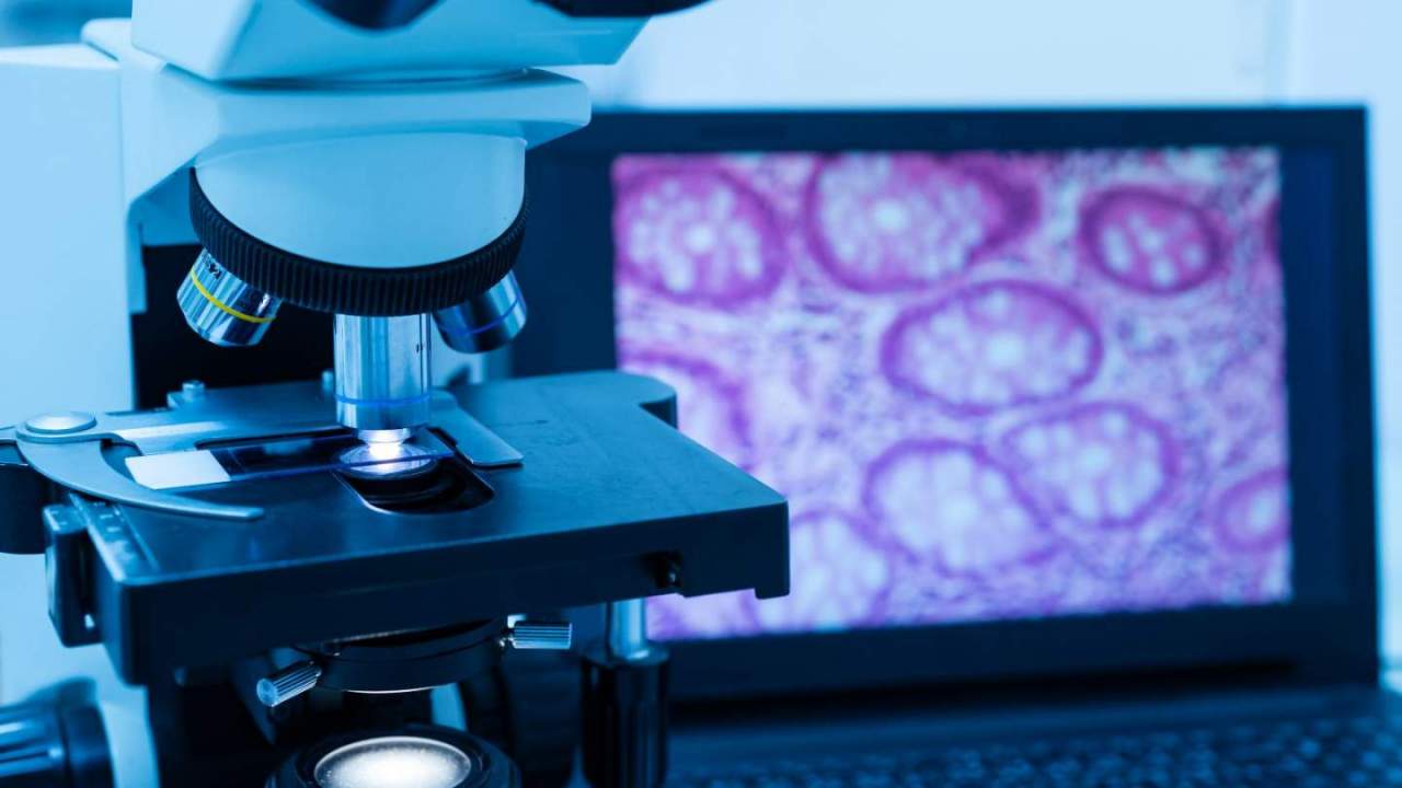 Cancer cells under microscope
